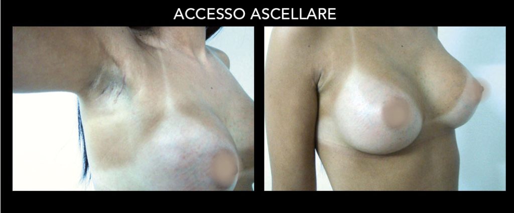 Mastoplastica Additiva: Procedure e Materiali: accesso ascellare